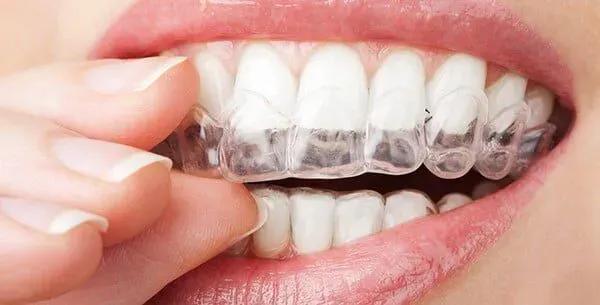 Invisalign